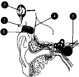 html 人工耳蜗工作原理,如上图"人工耳蜗示意图"所示: 1,麦克风拾取